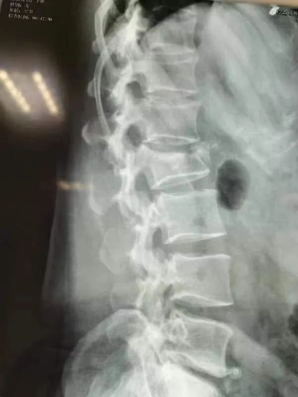 创伤小！「腰椎爆裂性骨折」，原来也可用微创手术治疗…