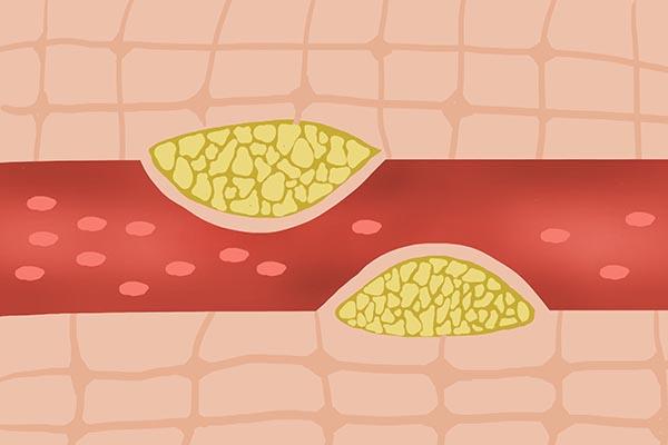 biorbyt（CD163抗体）文献：VEGFR2是稳定动脉粥样硬化（静脉移植物）疾病的有吸引力的靶点
