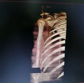 桂林医学院附属医院 3D 打印导板辅助微创治疗肱骨近端粉碎性骨折