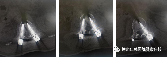 天玑骨科机器人辅助骨科微创手术 5 个「小孔」修复腰椎骨折