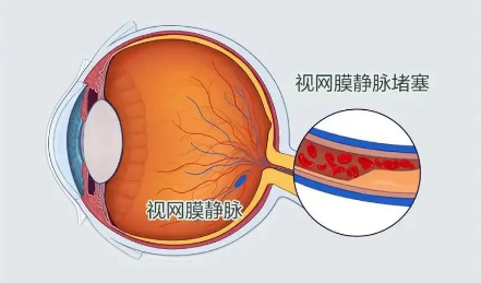 得了高血压还会瞎?警惕视网膜血管的「隐藏杀手」