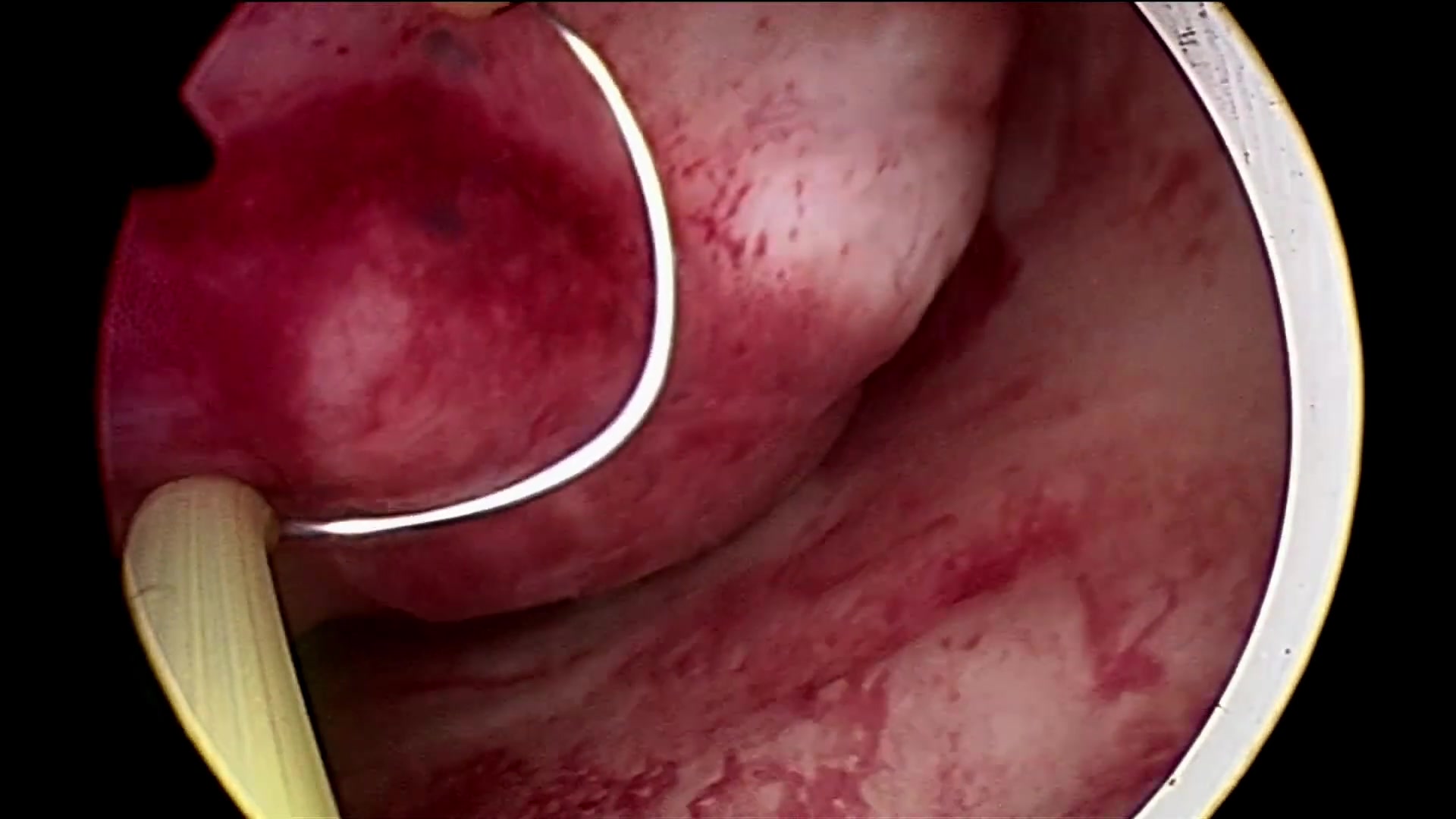 手术视频宫腔镜0型子宫肌瘤电切术4cm