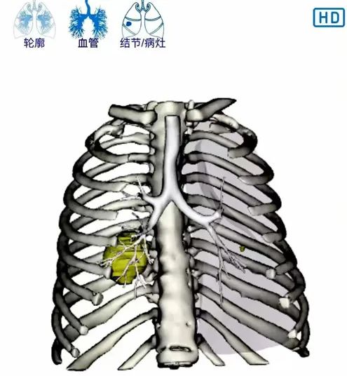郑州大学第五附属医院率先开展 IQQA-Guide 智能手术导航机器人引导下肿瘤精准粒子植入术