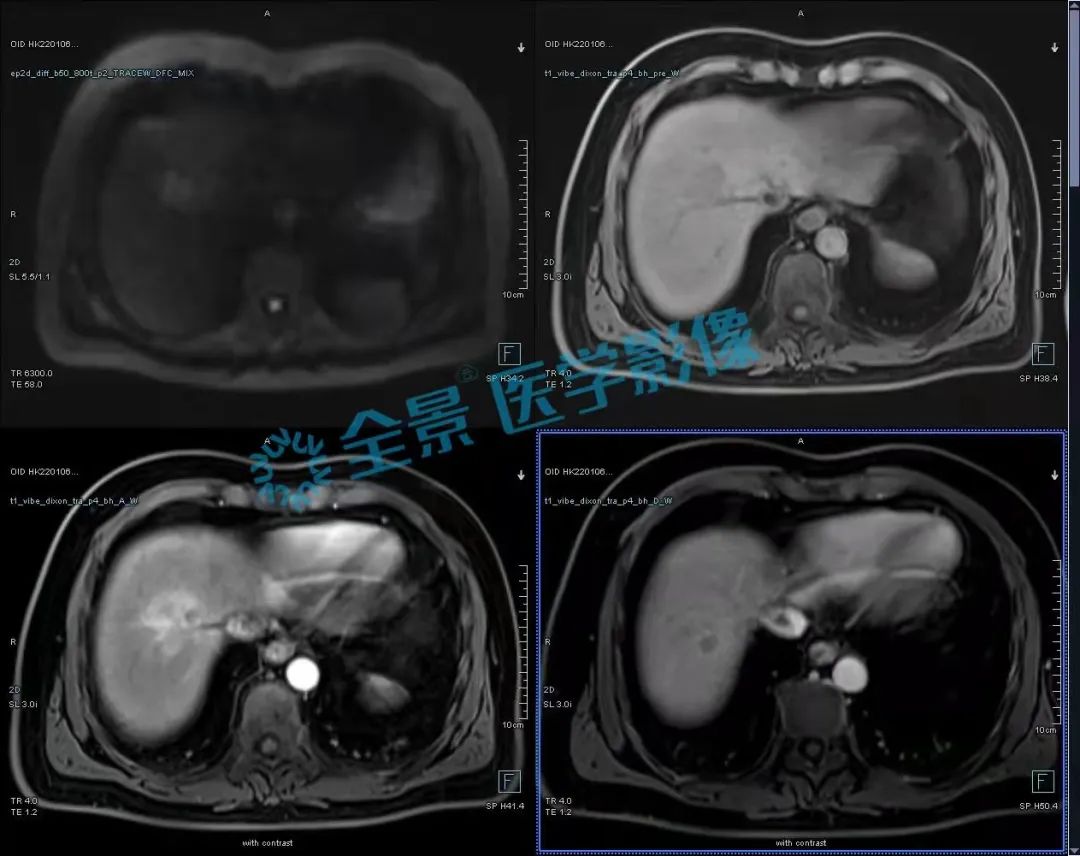 症状持续一年多，体检无异样，发现时却已是癌症晚期！