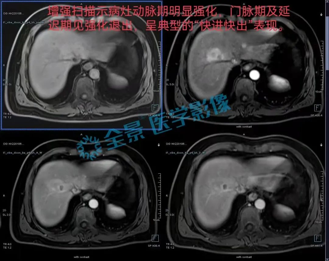 症状持续一年多，体检无异样，发现时却已是癌症晚期！