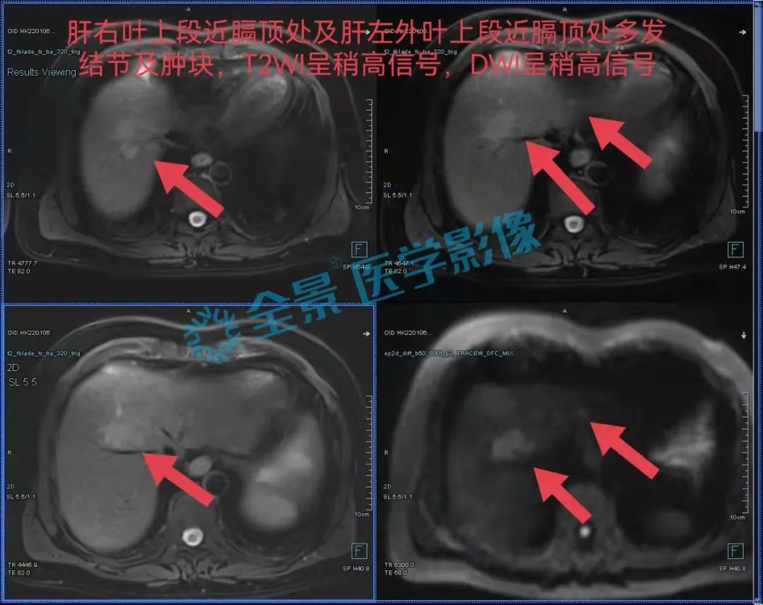 症状持续一年多，体检无异样，发现时却已是癌症晚期！