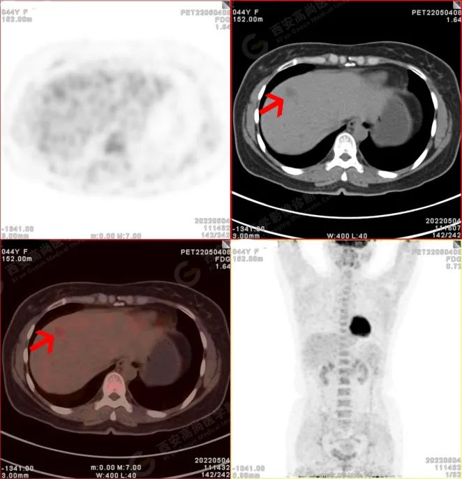 高尚病例：18F-FDG PET/CT-MR 多模态诊断腹膜后平滑肌肉瘤伴肝脏转移一例