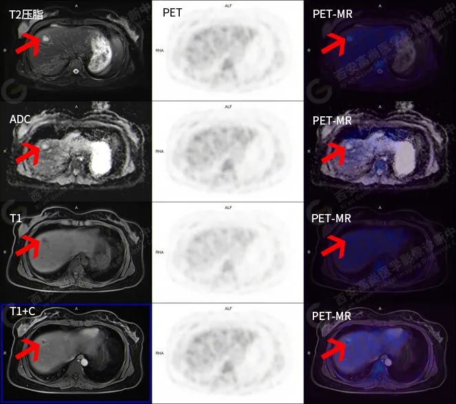高尚病例：18F-FDG PET/CT-MR 多模态诊断腹膜后平滑肌肉瘤伴肝脏转移一例