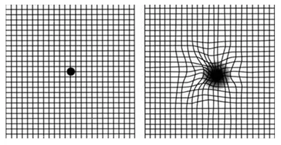 关注老年疾病:年龄相关性黄斑变性(AMD)