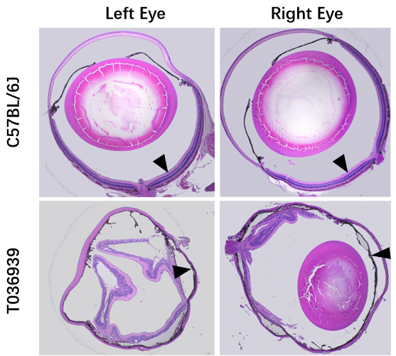 关注老年疾病:年龄相关性黄斑变性(AMD)