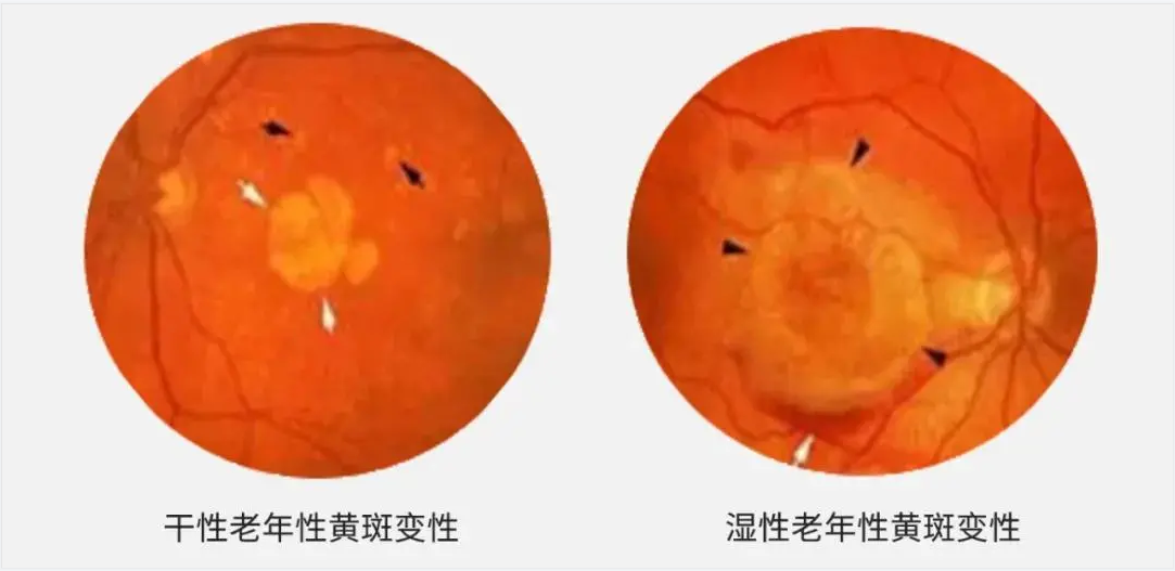 关注老年疾病:年龄相关性黄斑变性(AMD)