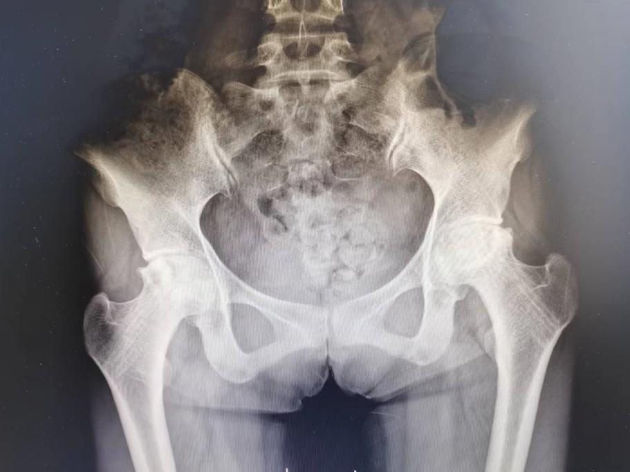24 岁少女双侧股骨头坏死导致无法行走！竟是这个原因引起的？