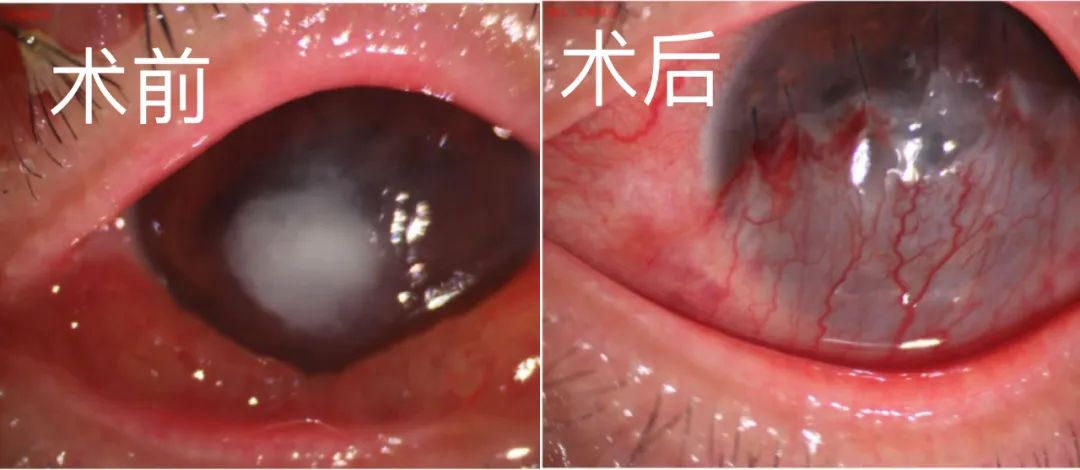 广西壮族自治区人民医院助眼角膜感染致溃疡孕妇免遭失明
