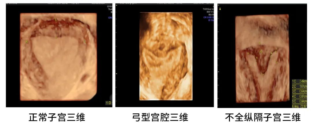 高尚病例：三维超声诊断子宫畸形：不全纵隔子宫-医院汇-丁香园