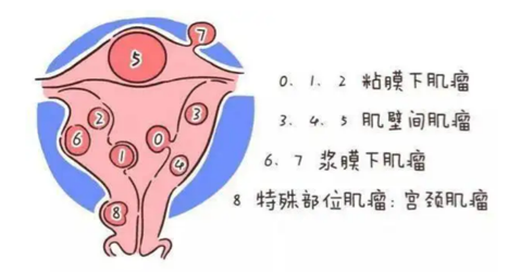 q1:有子宮肌瘤,能正常懷孕嗎?