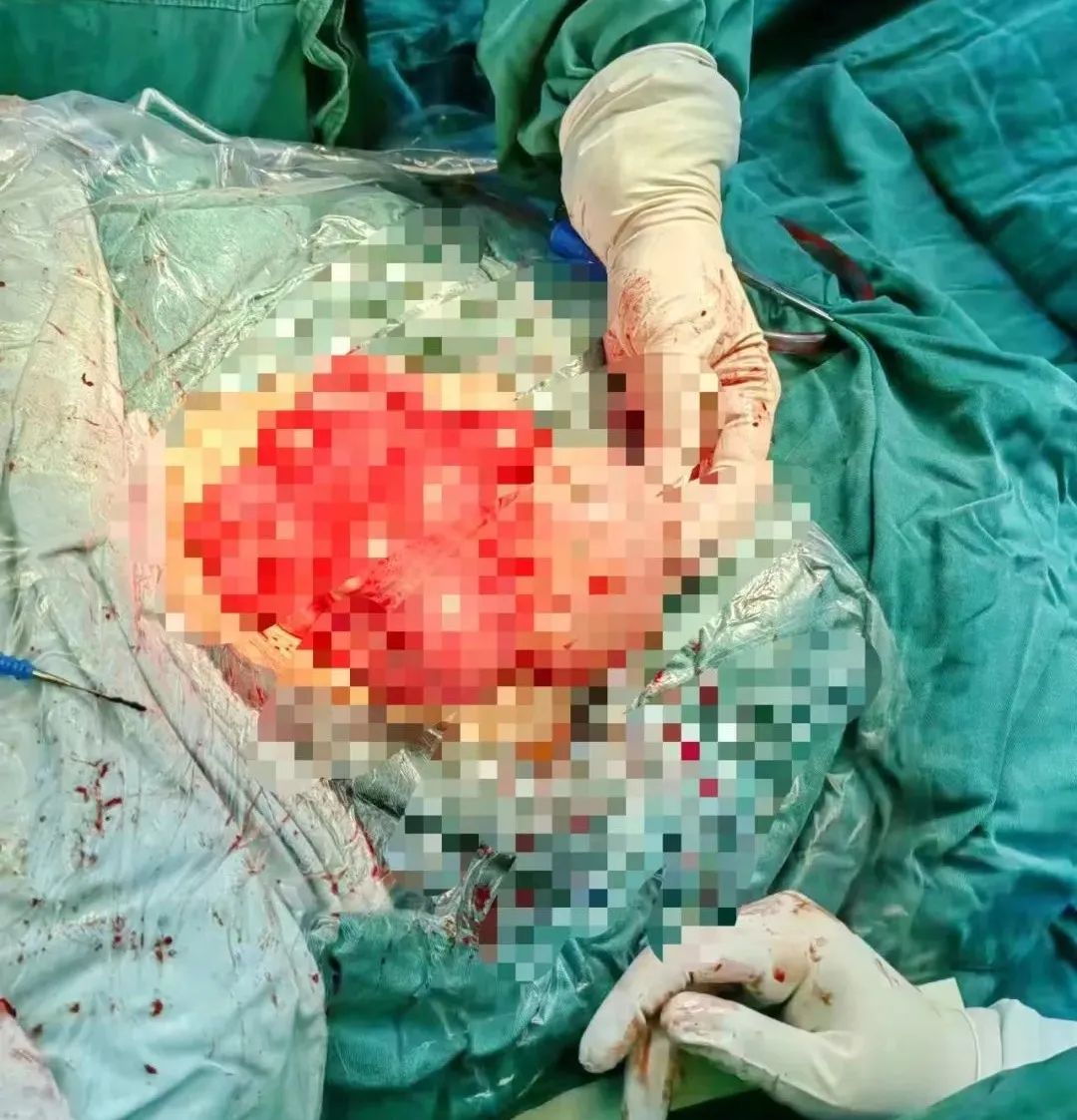 常德市第四人民医院成功完成一例多发复杂子宫肌瘤剥除术