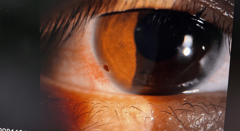 飞虫翅膀扒眼睛上致女子「红眼」近一月，武汉普瑞眼科医生：夏季警惕飞虫入眼