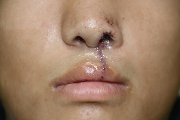 守护孩子微笑，湖南妇女儿童医院多学科协作成功完成唇腭裂手术