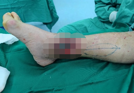 南京江北医院手足外科巧用穿支蒂皮瓣修复小腿缺损