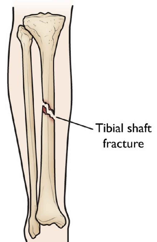兔胫骨骨折模型