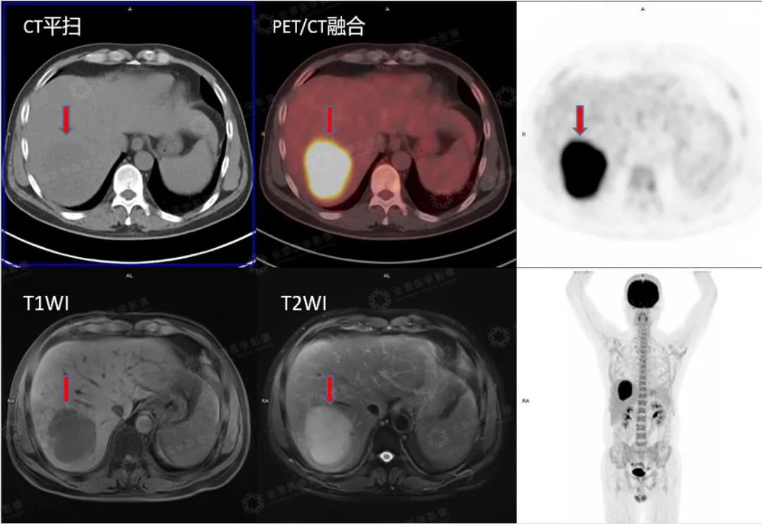 肝脏占位难定性，PET/CT-MR 异机融合鉴良恶！