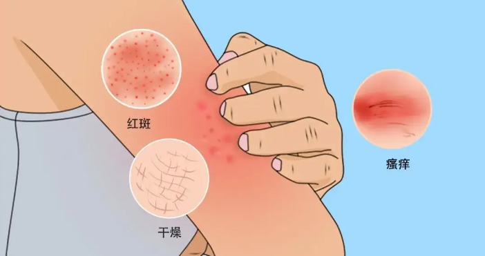 聊聊特应性皮炎药物实验用小鼠动物模型那些事