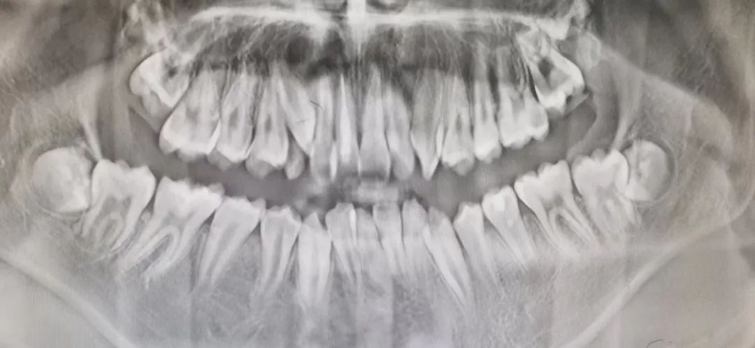 【学科建设】11 岁男孩摔掉门牙，家礼口腔团队成功为其重新植回去