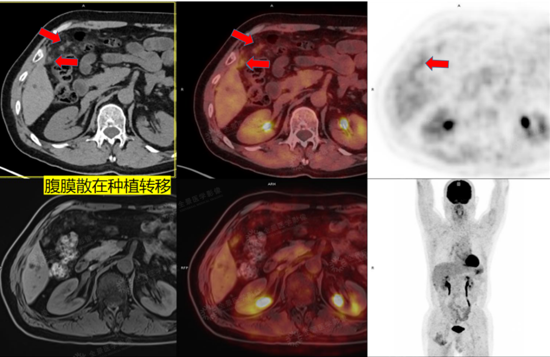 结肠癌术后评估，看 PET/CT-MR 如何「锁定」转移灶