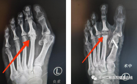 脚趾也能换关节，徐州仁慈医院率先在淮海地区开展跖趾关节置换手术