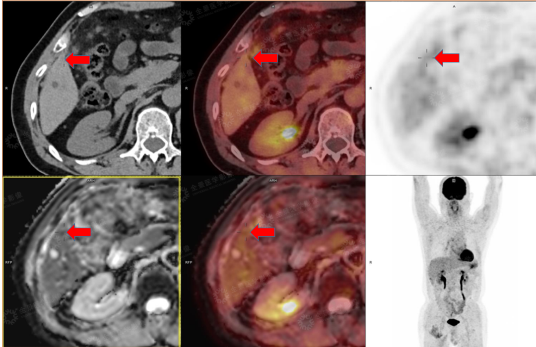 结肠癌术后评估，看 PET/CT-MR 如何「锁定」转移灶