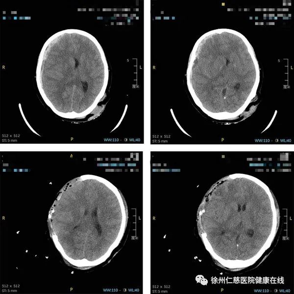 骑车不带头盔是道送命题!女子骑行摔倒致颅脑出血紧急抢救