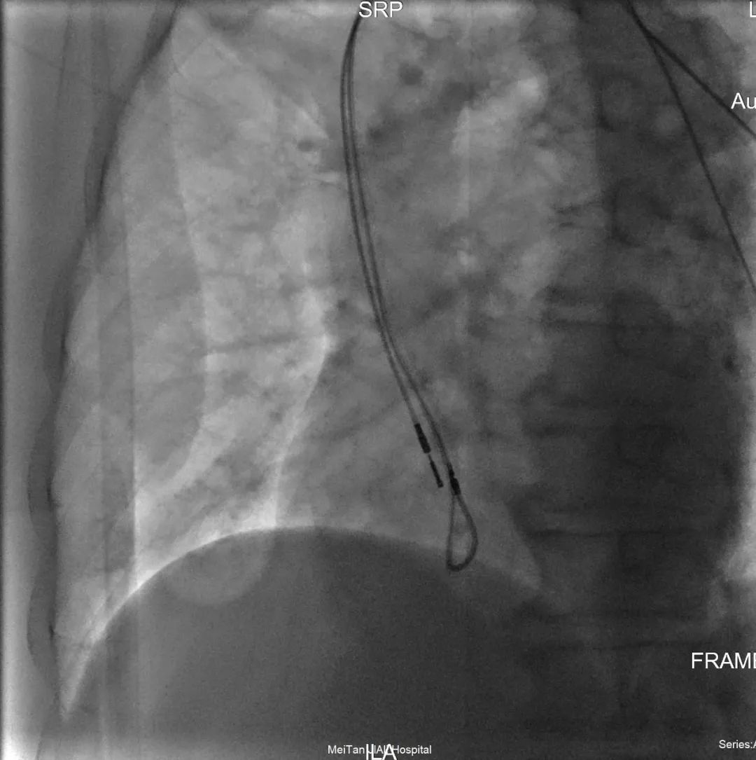 湄潭家礼医院完成抗核磁心脏起搏器植入术一例
