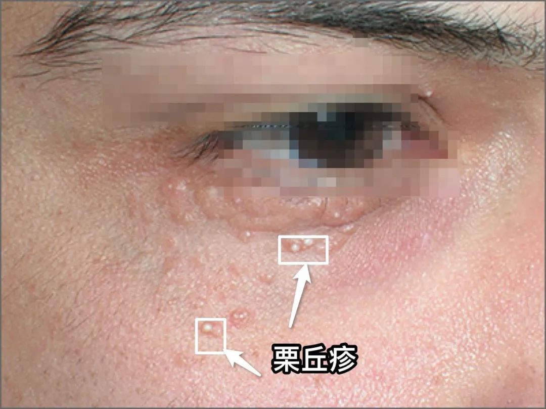 湿锐尖疣的早期症状(男性尖锐性湿疹疣早期症状) - 能源网(www.nengyuancn.com)