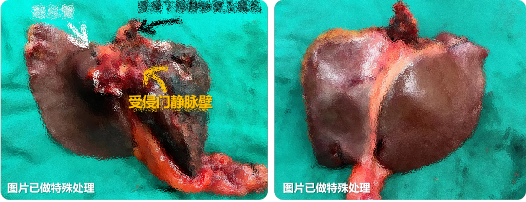 深圳市罗湖区人民医院普外科李海军教授团队成功完成一台「肝门部胆管癌根治术」