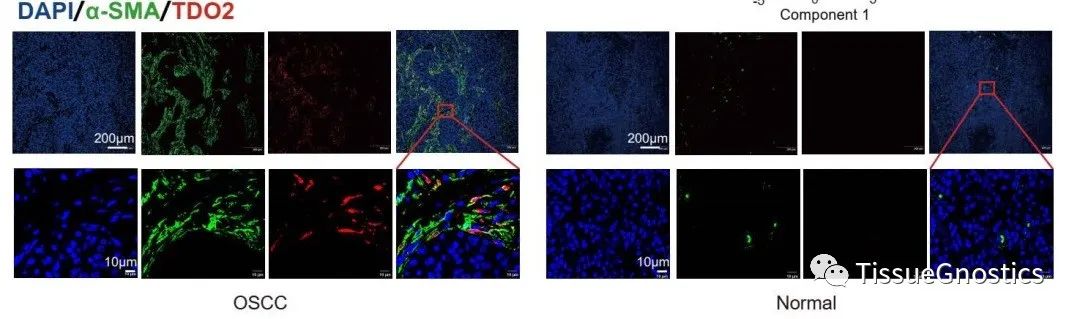 JCI | 中山大学北京大学联合揭示口腔肿瘤免疫逃逸机制和新的治疗靶点