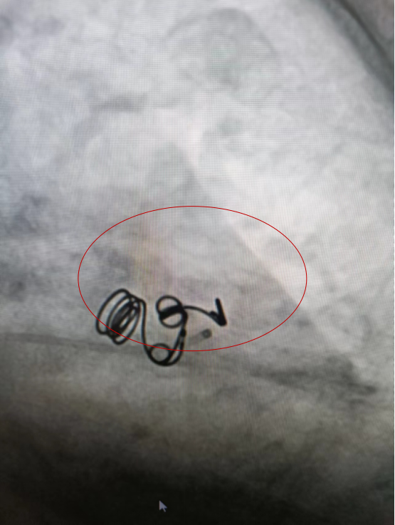 西安高新医院心脏大血管外科成功实施冠状动脉-肺动脉瘘介入封堵术