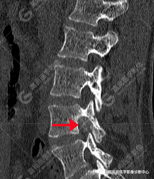 高尚病例：脊柱旁骨母细胞瘤一例
