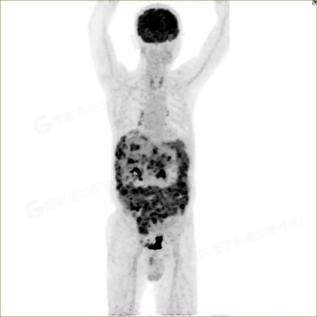 高尚病例：PET/CT 诊断脐尿管癌一例