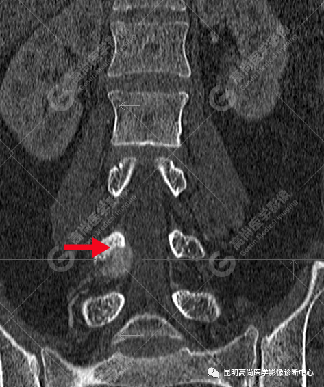 高尚病例：脊柱旁骨母细胞瘤一例