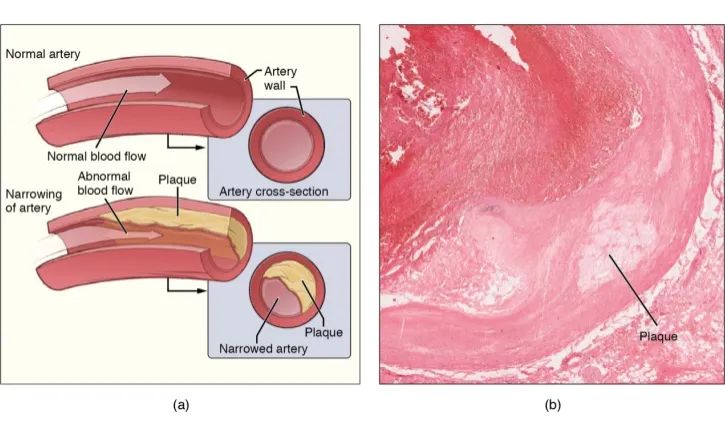 【新品推荐】AAV-PCSK9构建动脉粥样硬化模型
