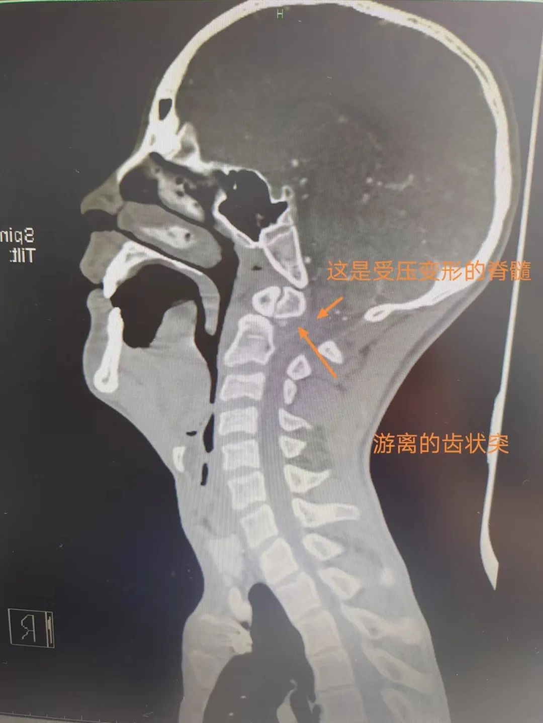 岳池县人民医院脊柱脊髓外科成功为 15 岁脑瘫患者施行高难度颈椎手术