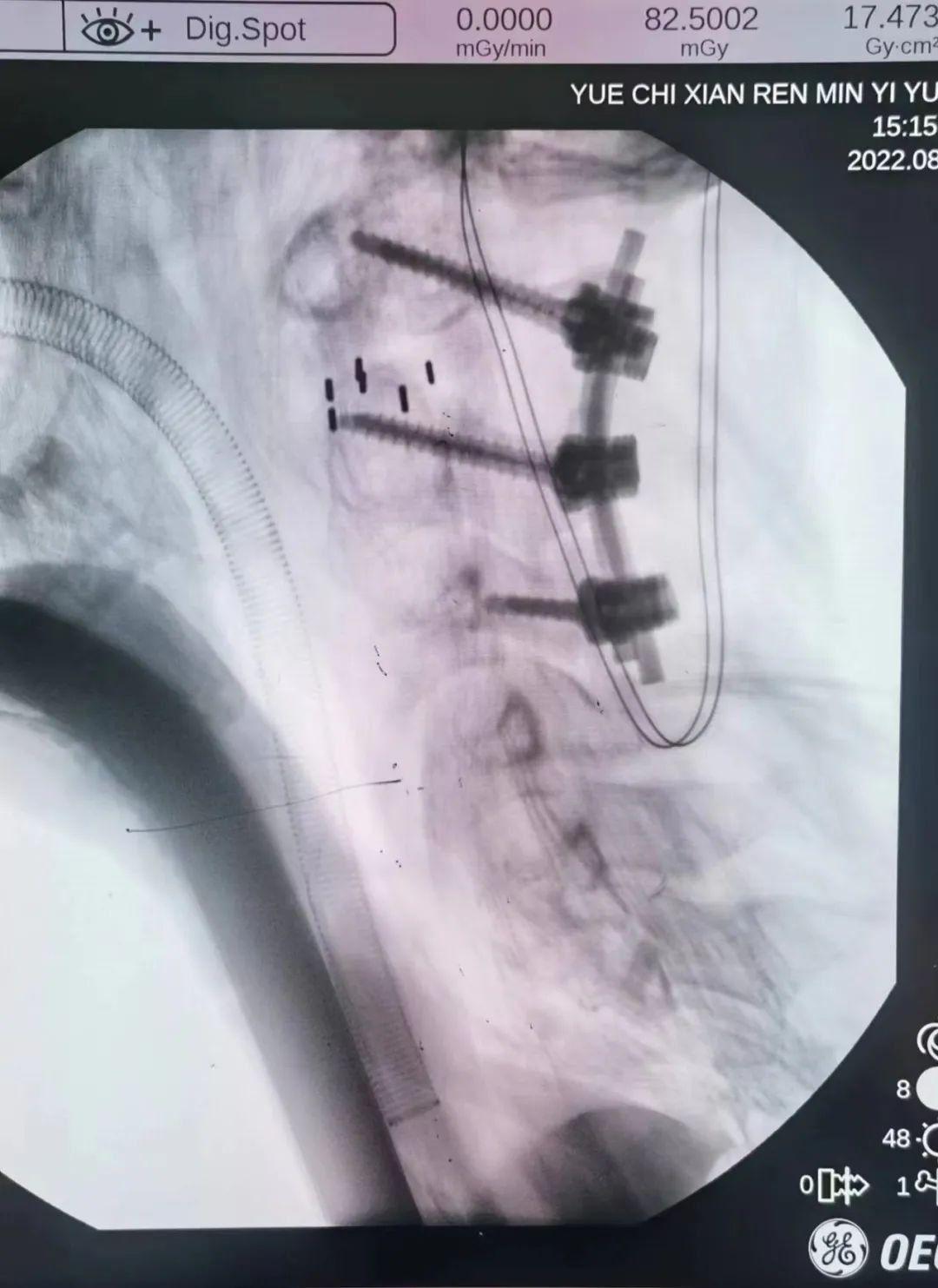 岳池县人民医院脊柱脊髓外科成功为 15 岁脑瘫患者施行高难度颈椎手术