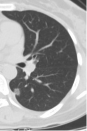发现肺结节该怎么办？如何正确判断肺结节的良恶性？