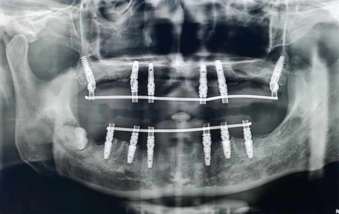 泰康拜博种植医与术，高难技术满足患者所需——口腔种植专题
