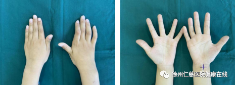 手指麻木，爪形手畸形，出现这些症状一定要小心