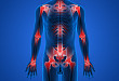 骨关节炎的痛觉敏化，如何选用止痛药物？