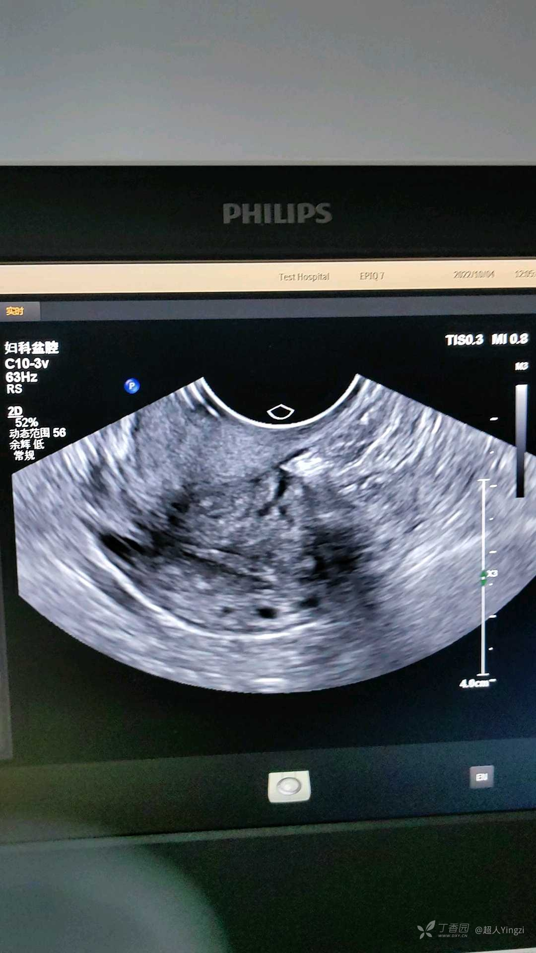 56岁女性闭经子宫萎缩宫腔内不规则强回声请教各位老师是节育器还是