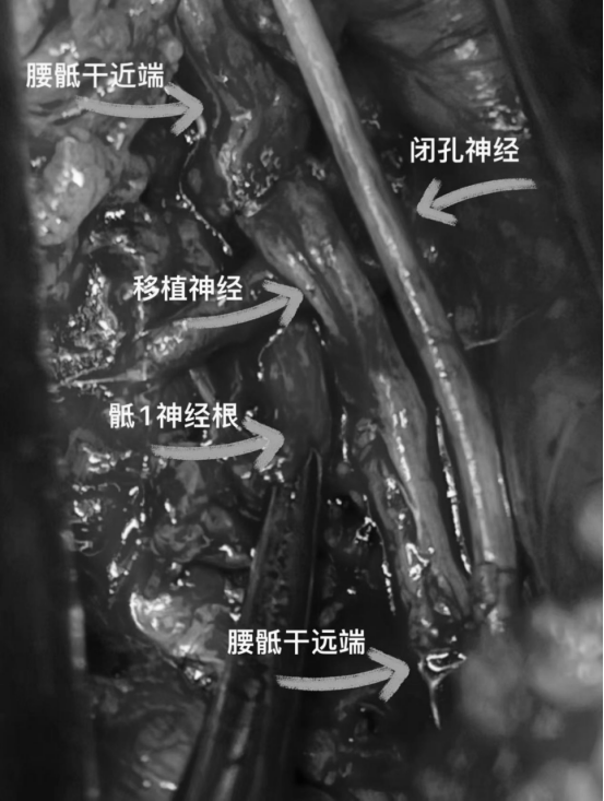 南昌大学二附院整形美容科完成一例腹膜后骶丛神经移植修复术