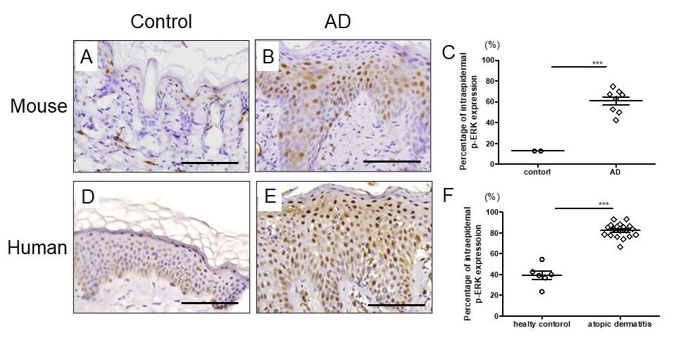 研究进展-ERK 通路在特应性皮炎（AD）发病中的作用机制及其作为治疗靶点的潜力