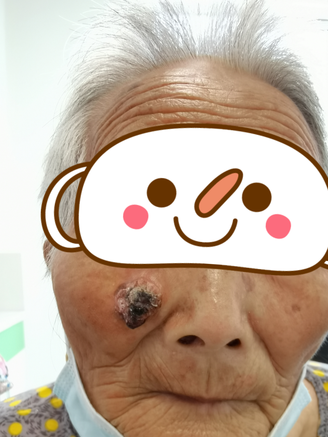 「米粒」抠成「鹌鹑蛋」：南京江北医院妙手切癌